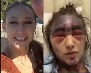 Two photos of Alexis Lorenze side by side.  In the first, a healthy and attractive young woman.  In the second, the same woman with dark bruising all around her scalp, neck, and face, with the area around the eyes puffed up and red, and the entire forehead purple.